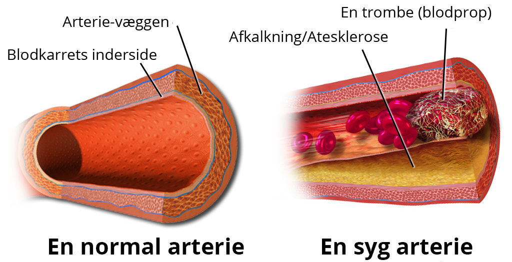 aareforkalkning