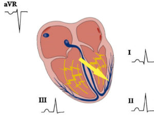 Heart-ventricular-depol-frontal-leads-jpg