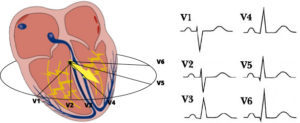 Heart-ventriular-depol-horizontal-leads-ecg-jpg