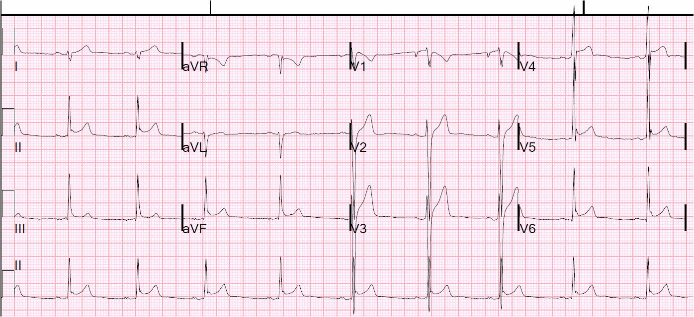 ST-elevation inferior