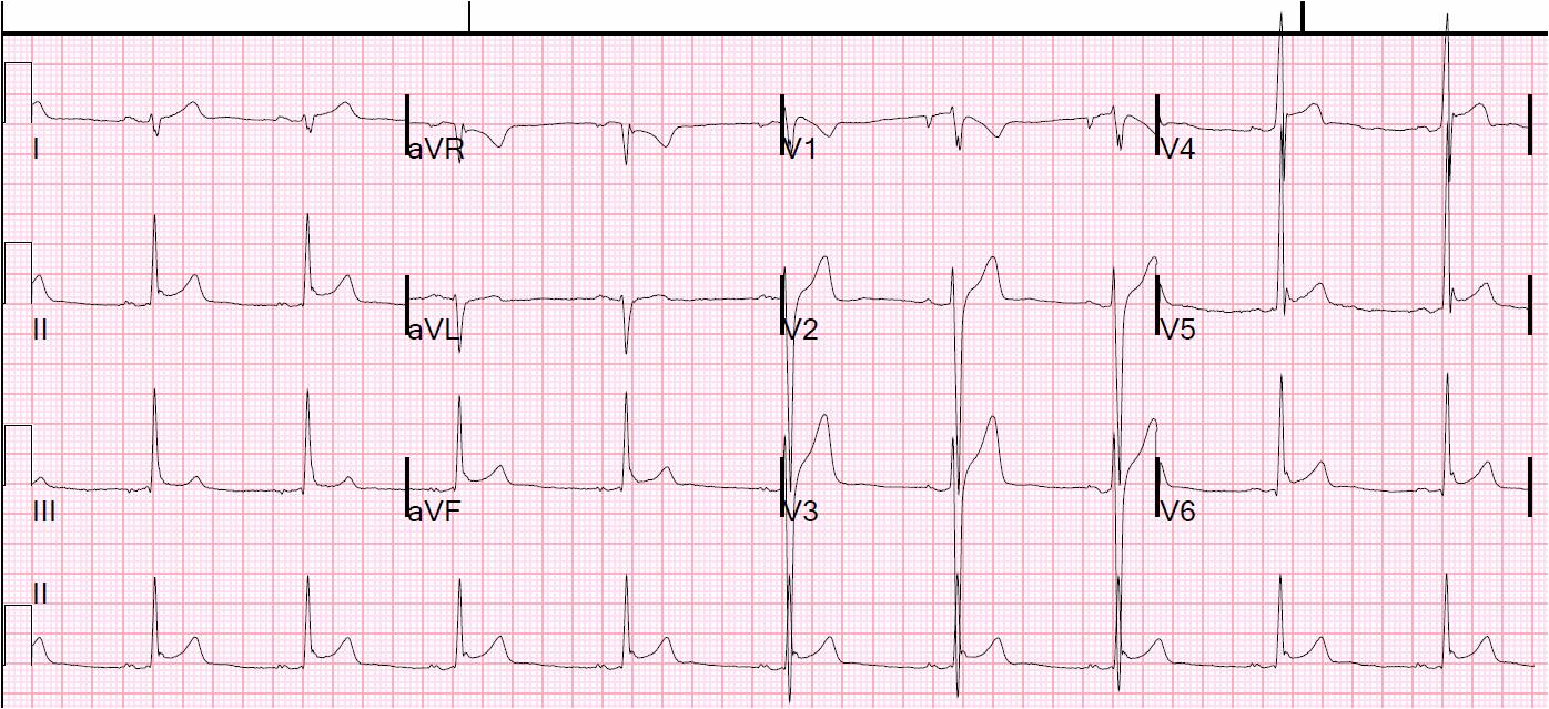 ST-elevation inferior