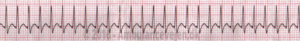 supra-ventricular-tachycardy-defi2