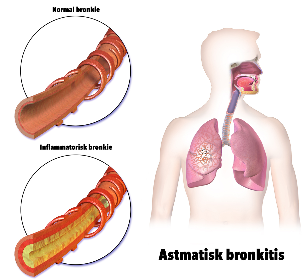 asmatic-bronchitis-revoke-jpg